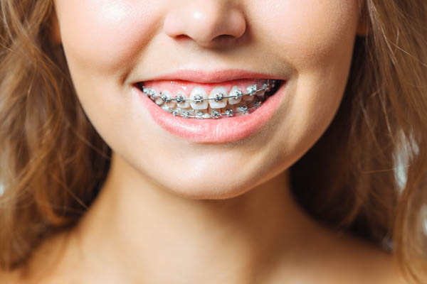 Why Clear Braces for Teens Are Recommended - Brea Pediatric Dental